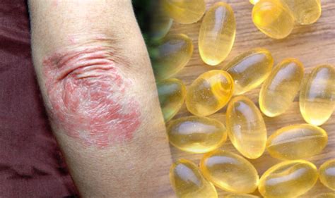 omega 3 for psoriasis treatment